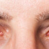 Dry Eye Syndrome Facts A Comprehensive Guide