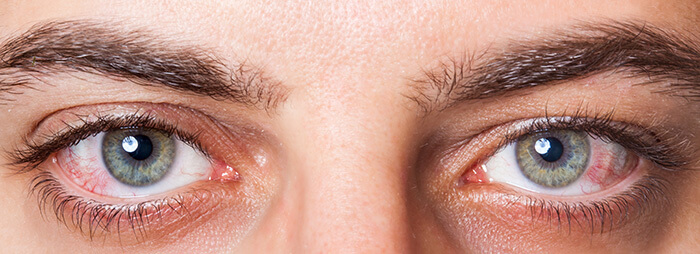 Dry Eye Syndrome Facts A Comprehensive Guide