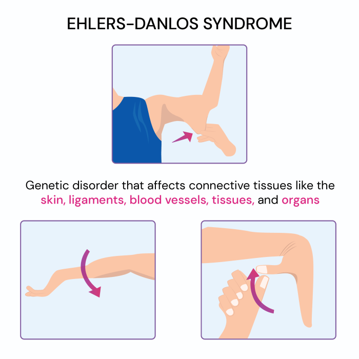 Ehlers danlos syndrome overview