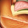 Eye Injections for AMD A Comprehensive Guide
