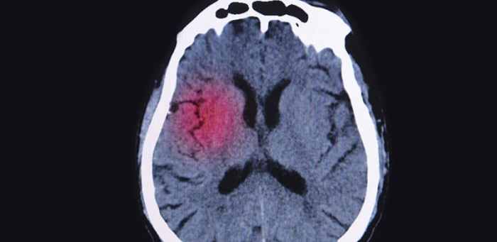 Migraine and Multiple Sclerosis Connection Unveiling the Link