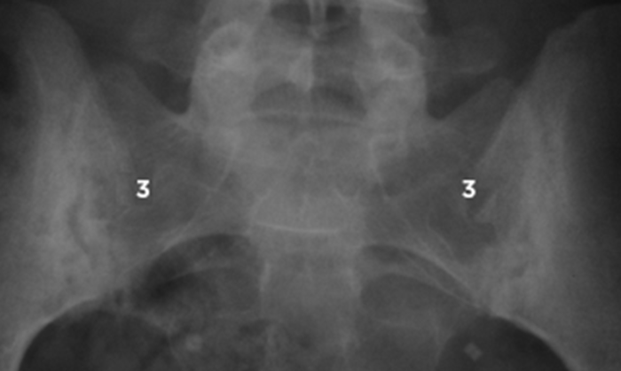 Achieving ASAS40 Improves Patient-Reported Outcomes in Ankylosing Spondylitis - Rheumatology Advisor Ankylosing spondylitis and teeth problems