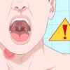 Sore Throat No Fever Causes & Treatment