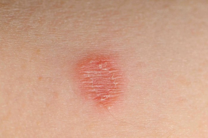Ringworm vs eczema symptoms