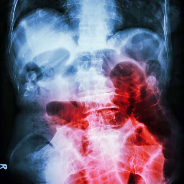 Surgery for a bowel obstruction