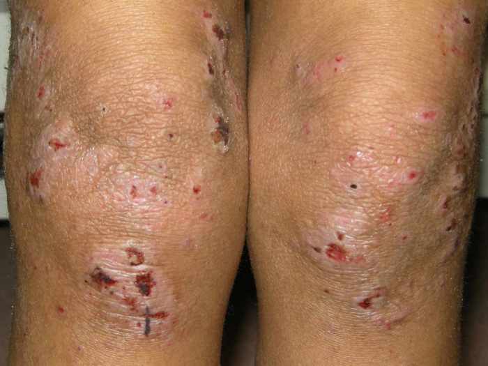 Atopic dermatitis vs eczema