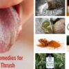 Oral Thrush Home Remedies A Guide