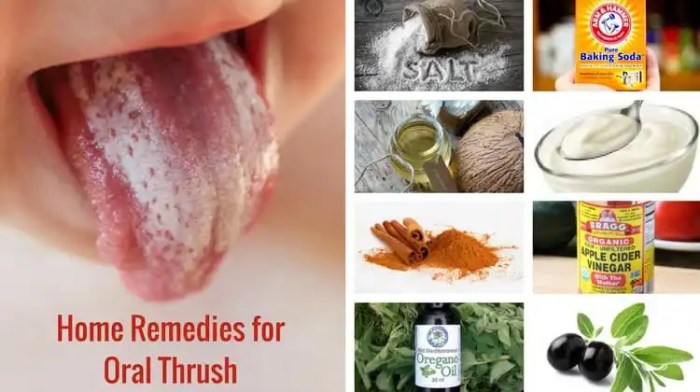 8 Best Home Remedies for Oral Thrush Oral thrush home remedies