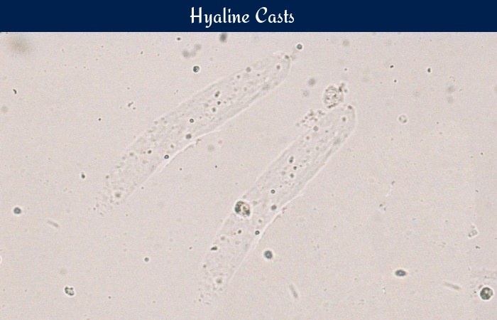 Hyaline casts in urine