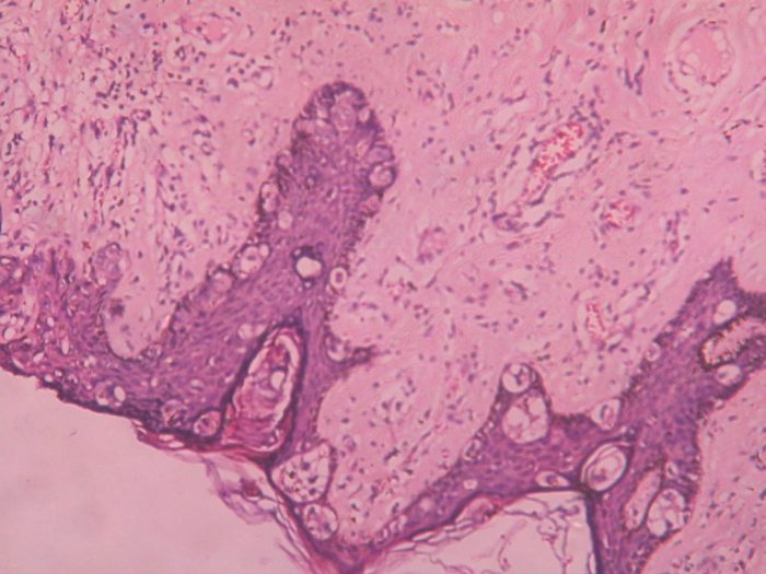 Pagets disease of the breast