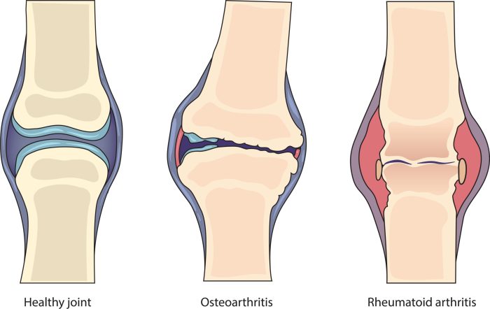 Rheumatoid arthritis vs arthritis