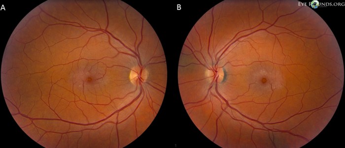 Macular telangiectasia eye disease