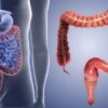 Treatment of Colon Cancer A Comprehensive Guide