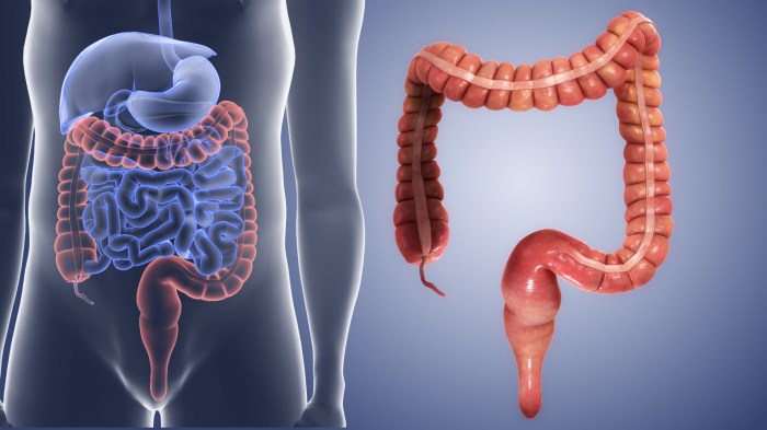 Treatment of colon cancer
