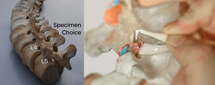 What are herniated disc symptoms