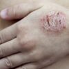 Eczema and COVID Vaccine A Deep Dive