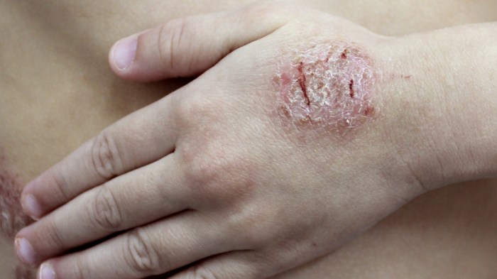 Eczema and COVID Vaccine A Deep Dive