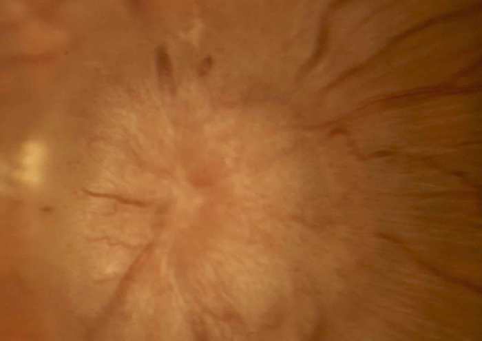 Papilledema Symptoms Causes, Diagnosis, and Treatment