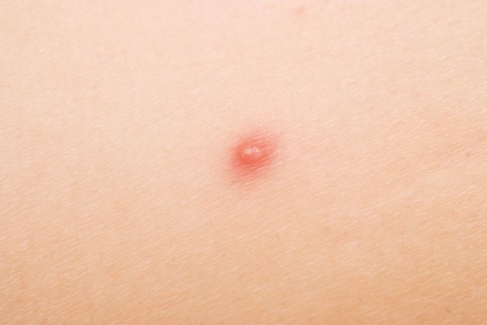 Papule vs Pustule vs Nodule: Pictures, Differences, and Causes Papule definition of an acne papule