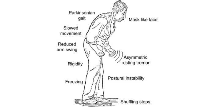 Our Parkinson's Place: In PD, Difficulty Walking May Be Due to Impaired ... Gait training in physical therapy