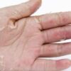What is Acral Peeling Skin Syndrome? A Deep Dive