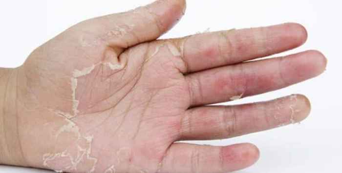 What is Acral Peeling Skin Syndrome? A Deep Dive