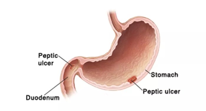 Best hospital for Peptic Ulcer Surgery | Smiles Gastroenterology Rectal ulcer overview and more
