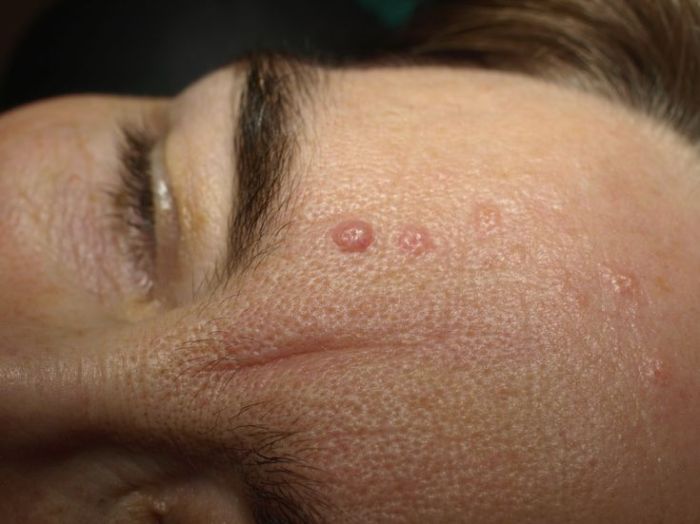 Sebaceous Hyperplasia Causes, Symptoms, and Treatments Sebaceous hyperplasia causes symptoms and treatments
