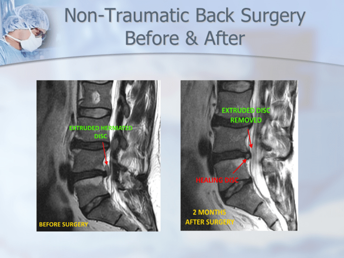 What are herniated disc symptoms