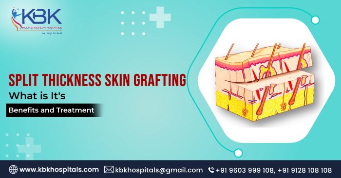 Medical Abbreviation Split-Thickness Skin Graft at June Blackwell blog How graft versus host disease gvhd is diagnosed