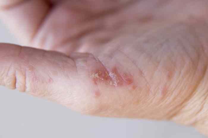 Hand Interdigital Dermatitis Dyshidrotic Eczema On Foto Stok 1919875409 | Shutterstock Signs of fibroids breaking down
