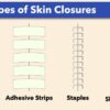 Incision Closed Sutures, Staples, Glue