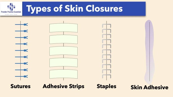 Incision closed sutures staples glue