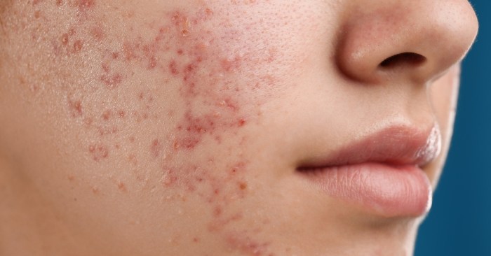 What is acne surgery