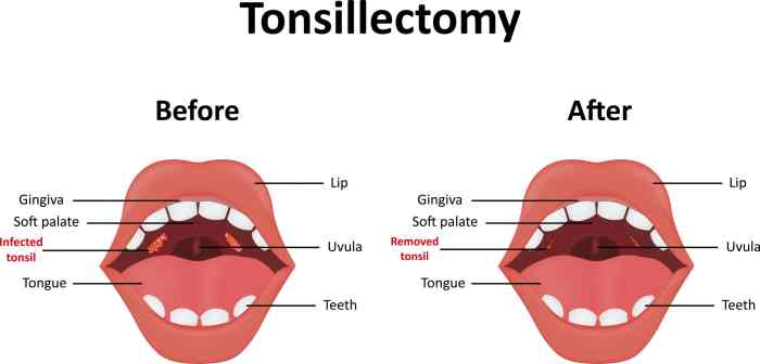 Tonsillectomy: Preparation, Recovery, Long-Term Care Tonsillectomy risks versus benefits is it worth it