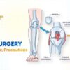 How ACL Surgery Is Performed A Comprehensive Guide