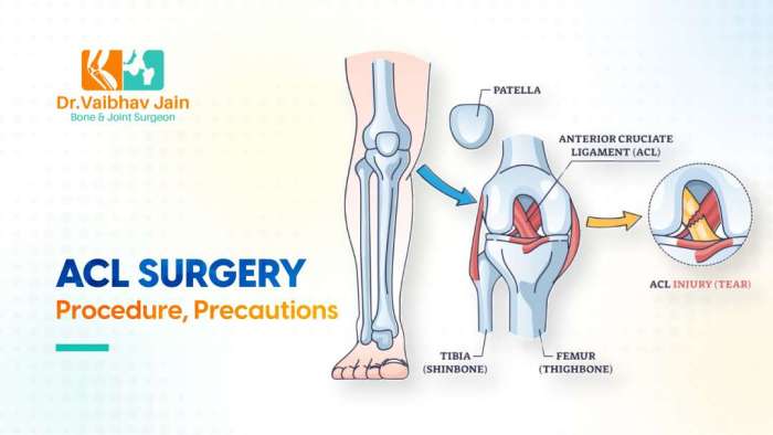How acl surgery is performed