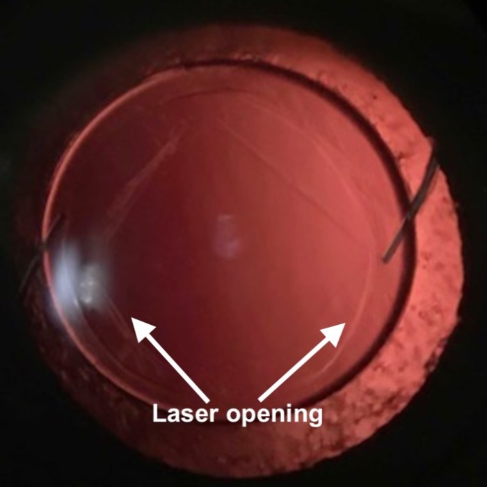 Yag Posterior Capsulotomy in River Falls, WI | River Falls Eye Surgery ... Yag laser posterior capsulotomy