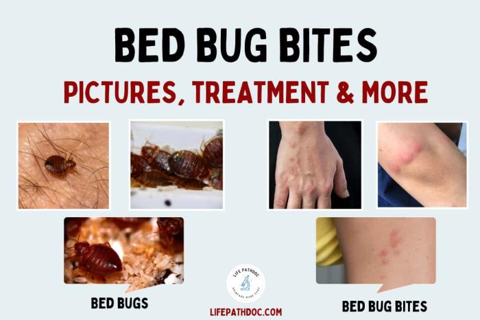 How to treat bed bug bites