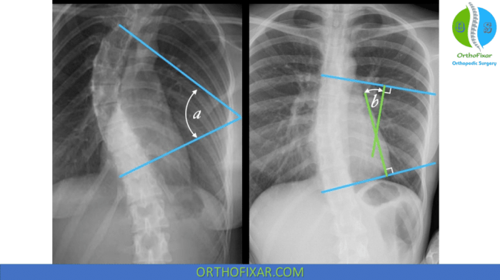 Cobb Angle For Scoliosis | OrthoFixar 2025 Cobbs angle and scoliosis