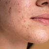 Hypochlorous Acid Acne Body Odor A Deep Dive