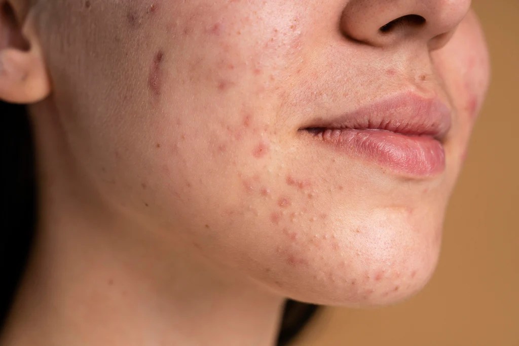 Hypochlorous acid acne body odor
