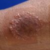 Ringworm vs Eczema Symptoms A Deep Dive
