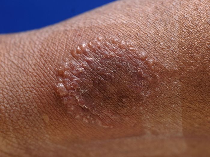 Ringworm vs Eczema Symptoms A Deep Dive