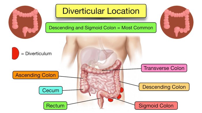 How To Eliminate Constipation And Cleanse Your Colon Colonoscopy nejm study controversy
