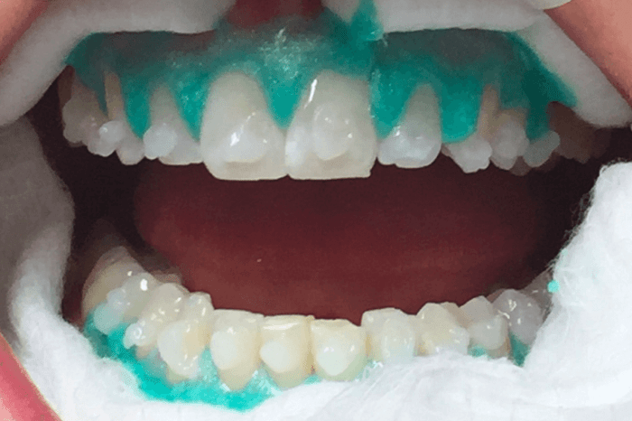 Does hydrogen peroxide whiten teeth