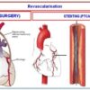 What is a Double Bypass Heart Surgery? A Comprehensive Guide