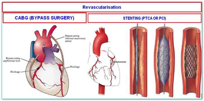 Nursing diagnosis for cabg - Special Mentality What is a double bypass heart surgery