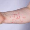 Congenital Adrenal Hyperplasia Symptoms A Deep Dive