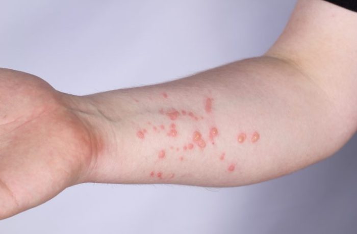 Signs metformin not working
